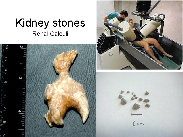 Kidney stones Renal Calculi Kidney stones Renal Calculi