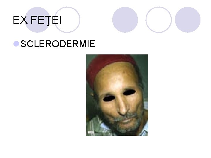 EX FEŢEI l SCLERODERMIE EX FEŢEI l SCLERODERMIE