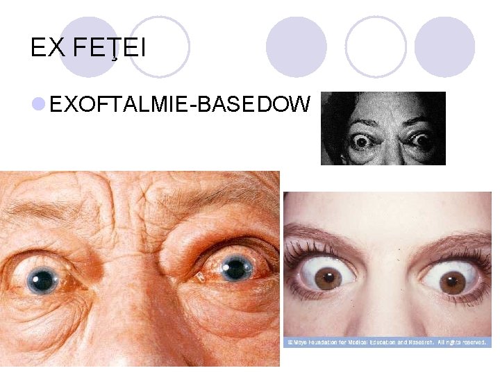 EX FEŢEI l EXOFTALMIE-BASEDOW EX FEŢEI l EXOFTALMIE-BASEDOW