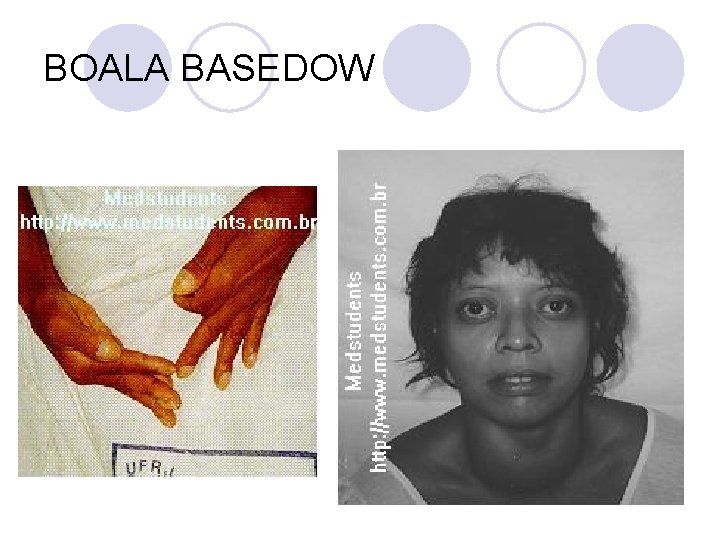 BOALA BASEDOW BOALA BASEDOW