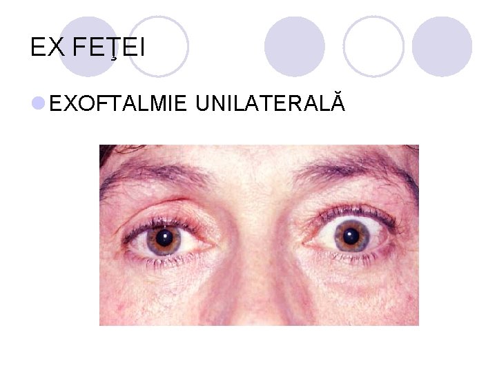 EX FEŢEI l EXOFTALMIE UNILATERALĂ EX FEŢEI l EXOFTALMIE UNILATERALĂ