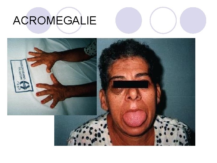 ACROMEGALIE ACROMEGALIE