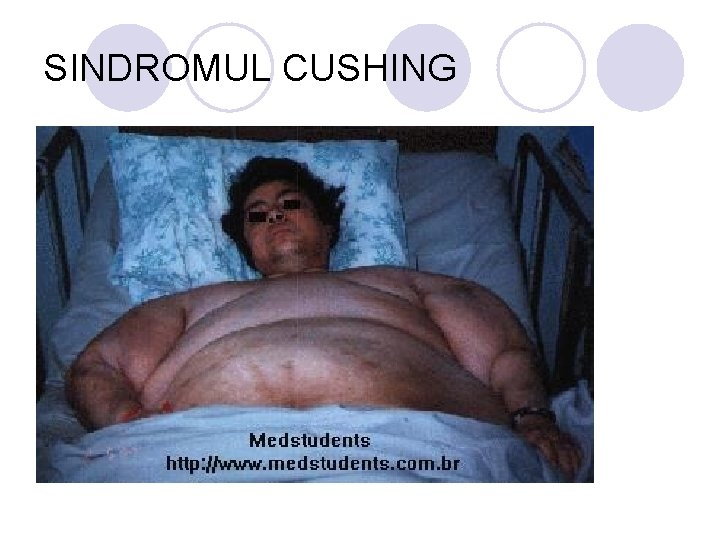 SINDROMUL CUSHING SINDROMUL CUSHING