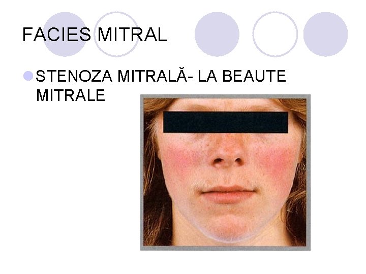 FACIES MITRAL l STENOZA MITRALĂ- LA BEAUTE MITRALE FACIES MITRAL l STENOZA MITRALĂ- LA BEAUTE MITRALE
