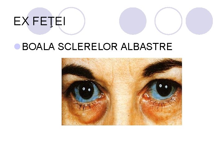 EX FEŢEI l BOALA SCLERELOR ALBASTRE EX FEŢEI l BOALA SCLERELOR ALBASTRE