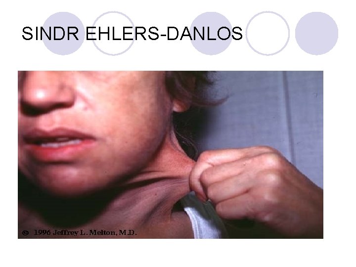SINDR EHLERS-DANLOS SINDR EHLERS-DANLOS