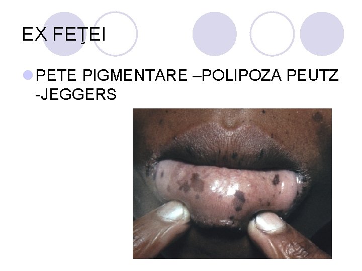 EX FEŢEI l PETE PIGMENTARE –POLIPOZA PEUTZ -JEGGERS EX FEŢEI l PETE PIGMENTARE –POLIPOZA PEUTZ -JEGGERS