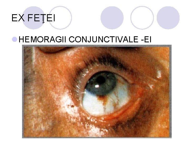 EX FEŢEI l HEMORAGII CONJUNCTIVALE -EI EX FEŢEI l HEMORAGII CONJUNCTIVALE -EI