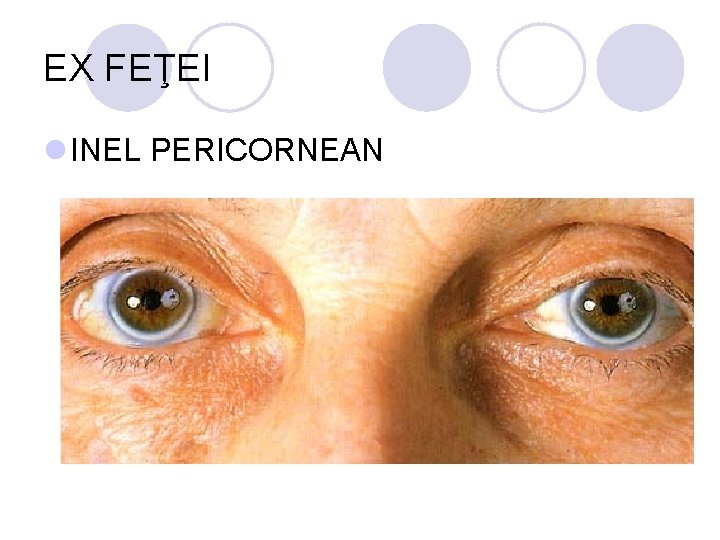 EX FEŢEI l INEL PERICORNEAN EX FEŢEI l INEL PERICORNEAN