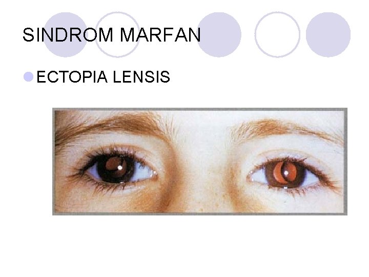 SINDROM MARFAN l ECTOPIA LENSIS SINDROM MARFAN l ECTOPIA LENSIS