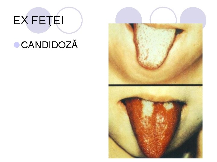 EX FEŢEI l CANDIDOZĂ EX FEŢEI l CANDIDOZĂ