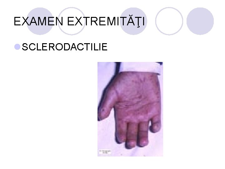 EXAMEN EXTREMITĂŢI l SCLERODACTILIE EXAMEN EXTREMITĂŢI l SCLERODACTILIE