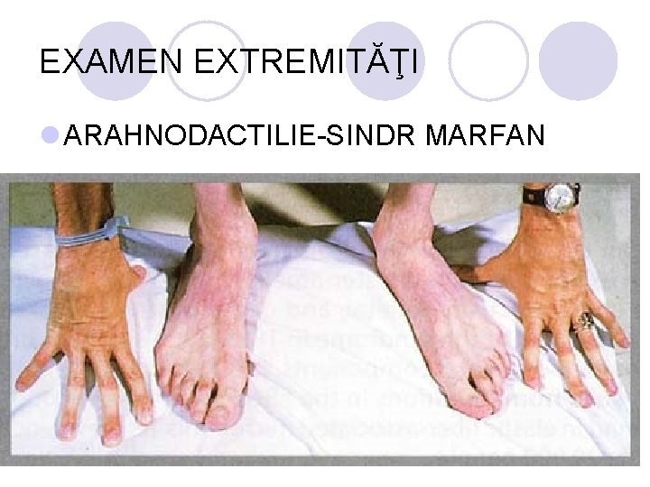 EXAMEN EXTREMITĂŢI l ARAHNODACTILIE-SINDR MARFAN EXAMEN EXTREMITĂŢI l ARAHNODACTILIE-SINDR MARFAN