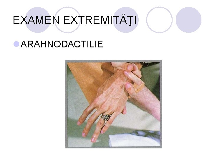 EXAMEN EXTREMITĂŢI l ARAHNODACTILIE EXAMEN EXTREMITĂŢI l ARAHNODACTILIE