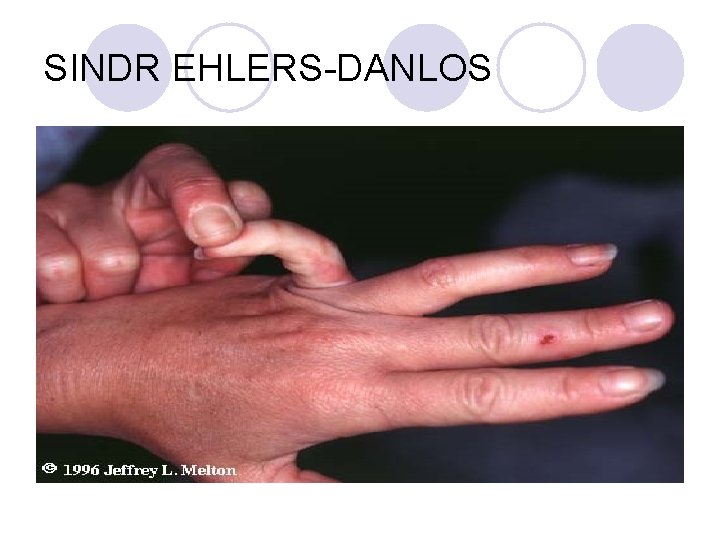 SINDR EHLERS-DANLOS SINDR EHLERS-DANLOS