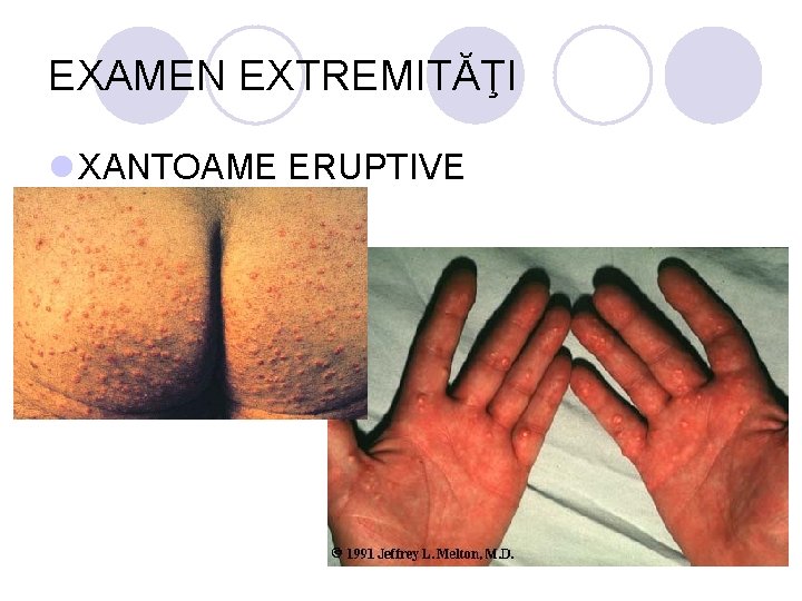 EXAMEN EXTREMITĂŢI l XANTOAME ERUPTIVE EXAMEN EXTREMITĂŢI l XANTOAME ERUPTIVE