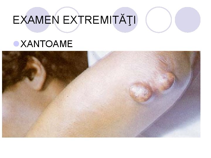 EXAMEN EXTREMITĂŢI l XANTOAME EXAMEN EXTREMITĂŢI l XANTOAME