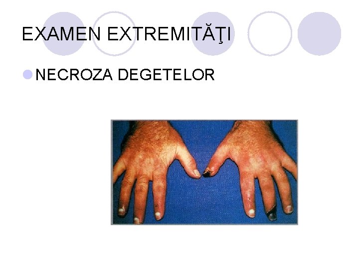 EXAMEN EXTREMITĂŢI l NECROZA DEGETELOR EXAMEN EXTREMITĂŢI l NECROZA DEGETELOR