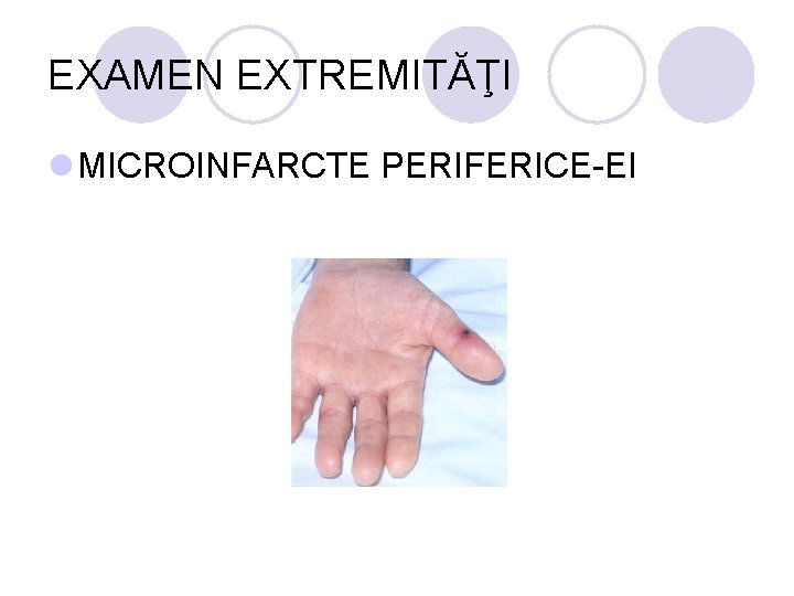 EXAMEN EXTREMITĂŢI l MICROINFARCTE PERIFERICE-EI EXAMEN EXTREMITĂŢI l MICROINFARCTE PERIFERICE-EI
