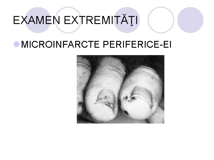 EXAMEN EXTREMITĂŢI l MICROINFARCTE PERIFERICE-EI EXAMEN EXTREMITĂŢI l MICROINFARCTE PERIFERICE-EI