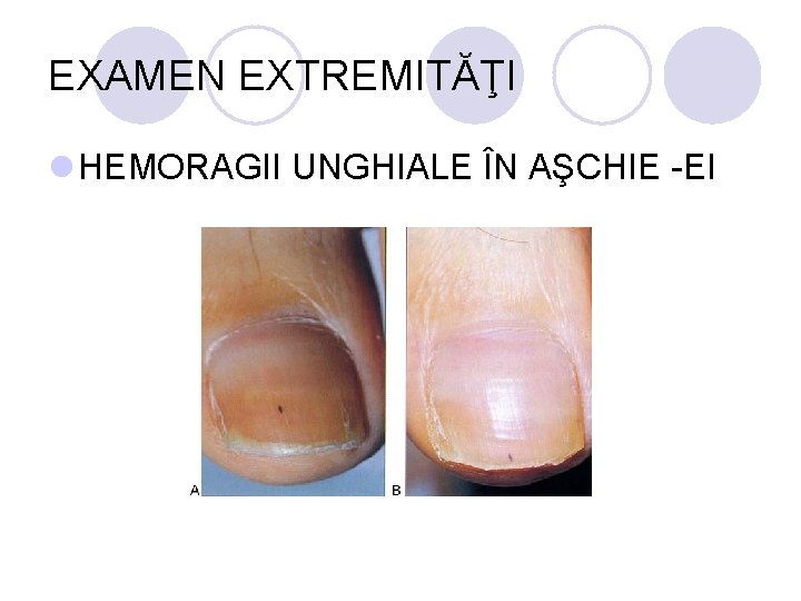 EXAMEN EXTREMITĂŢI l HEMORAGII UNGHIALE ÎN AŞCHIE -EI EXAMEN EXTREMITĂŢI l HEMORAGII UNGHIALE ÎN AŞCHIE -EI