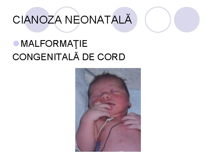 CIANOZA NEONATALĂ l MALFORMAŢIE CONGENITALĂ DE CORD CIANOZA NEONATALĂ l MALFORMAŢIE CONGENITALĂ DE CORD