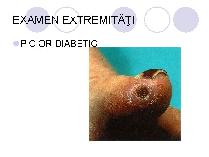 EXAMEN EXTREMITĂŢI l PICIOR DIABETIC EXAMEN EXTREMITĂŢI l PICIOR DIABETIC