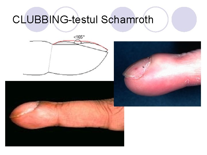 CLUBBING-testul Schamroth CLUBBING-testul Schamroth