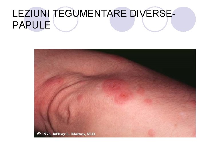 LEZIUNI TEGUMENTARE DIVERSEPAPULE LEZIUNI TEGUMENTARE DIVERSEPAPULE