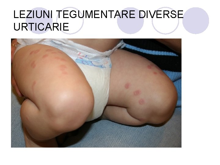 LEZIUNI TEGUMENTARE DIVERSE URTICARIE LEZIUNI TEGUMENTARE DIVERSE URTICARIE