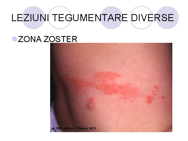 LEZIUNI TEGUMENTARE DIVERSE l ZONA ZOSTER LEZIUNI TEGUMENTARE DIVERSE l ZONA ZOSTER