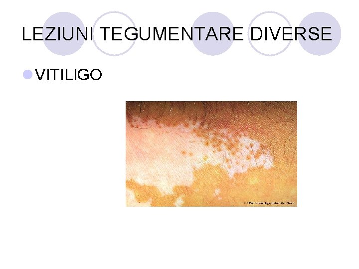 LEZIUNI TEGUMENTARE DIVERSE l VITILIGO LEZIUNI TEGUMENTARE DIVERSE l VITILIGO