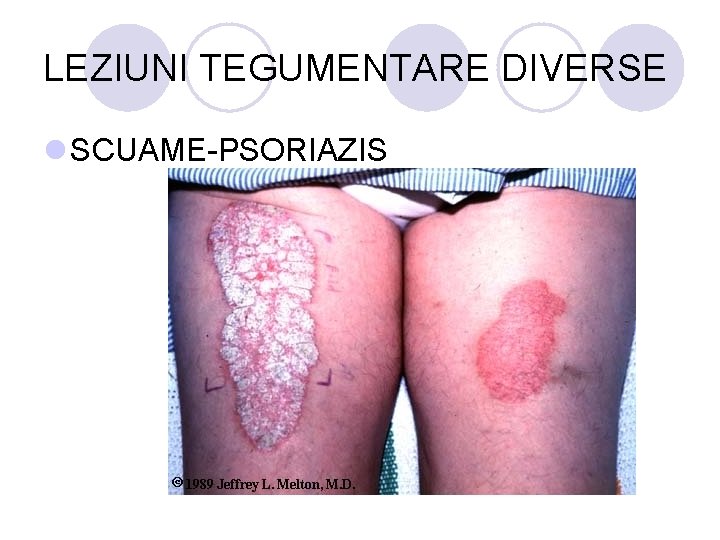 LEZIUNI TEGUMENTARE DIVERSE l SCUAME-PSORIAZIS LEZIUNI TEGUMENTARE DIVERSE l SCUAME-PSORIAZIS