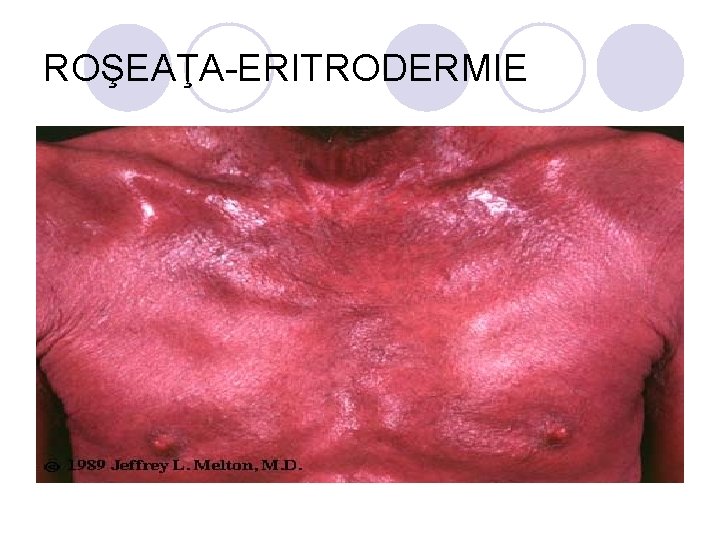 ROŞEAŢA-ERITRODERMIE ROŞEAŢA-ERITRODERMIE