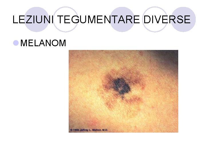 LEZIUNI TEGUMENTARE DIVERSE l MELANOM LEZIUNI TEGUMENTARE DIVERSE l MELANOM
