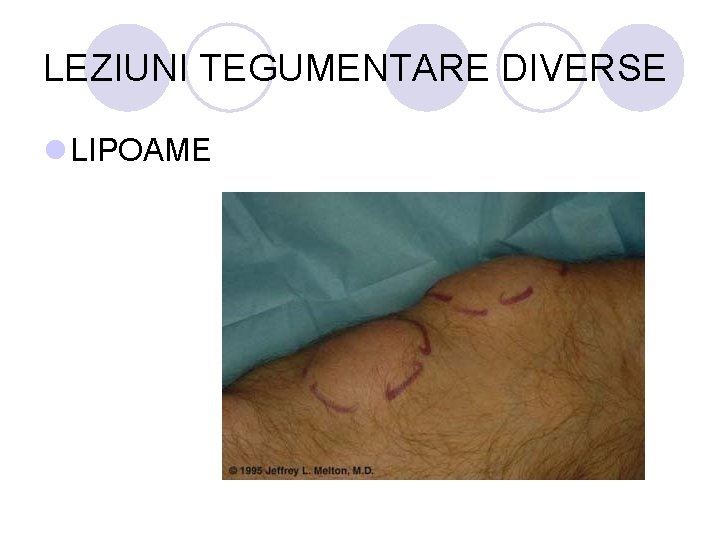 LEZIUNI TEGUMENTARE DIVERSE l LIPOAME LEZIUNI TEGUMENTARE DIVERSE l LIPOAME
