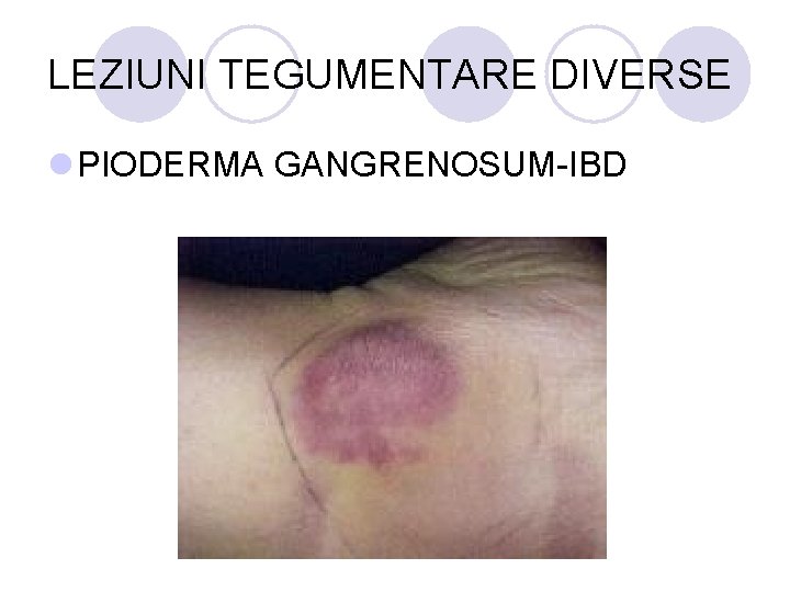 LEZIUNI TEGUMENTARE DIVERSE l PIODERMA GANGRENOSUM-IBD LEZIUNI TEGUMENTARE DIVERSE l PIODERMA GANGRENOSUM-IBD