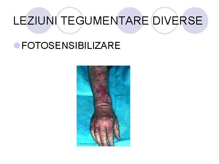 LEZIUNI TEGUMENTARE DIVERSE l FOTOSENSIBILIZARE LEZIUNI TEGUMENTARE DIVERSE l FOTOSENSIBILIZARE