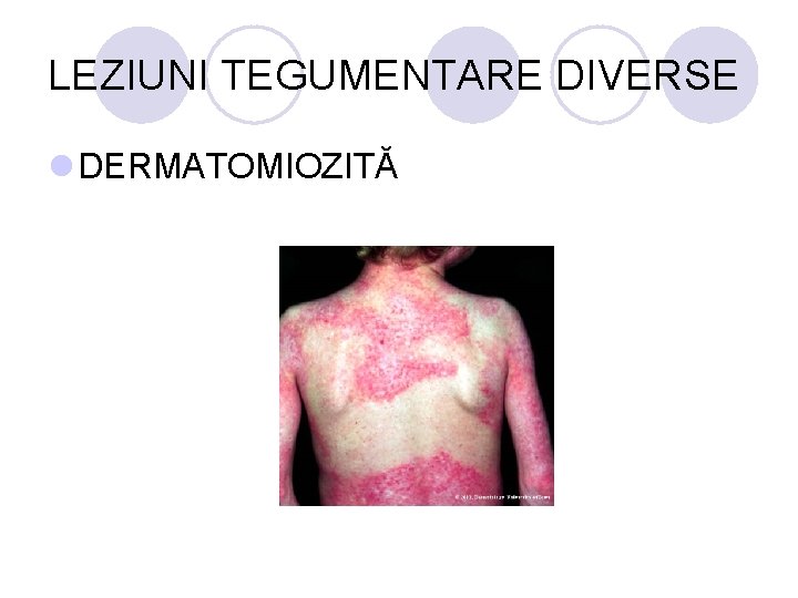 LEZIUNI TEGUMENTARE DIVERSE l DERMATOMIOZITĂ LEZIUNI TEGUMENTARE DIVERSE l DERMATOMIOZITĂ