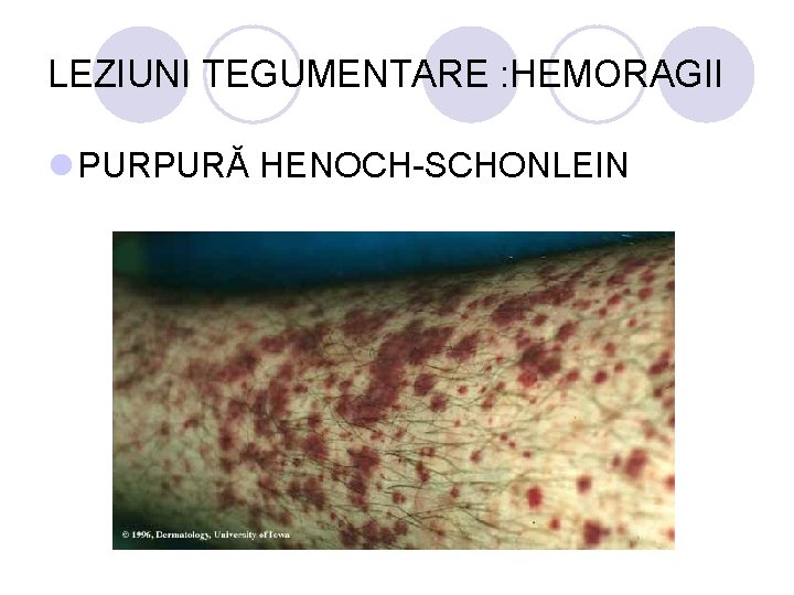 LEZIUNI TEGUMENTARE : HEMORAGII l PURPURĂ HENOCH-SCHONLEIN LEZIUNI TEGUMENTARE : HEMORAGII l PURPURĂ HENOCH-SCHONLEIN
