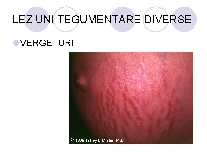 LEZIUNI TEGUMENTARE DIVERSE l VERGETURI LEZIUNI TEGUMENTARE DIVERSE l VERGETURI