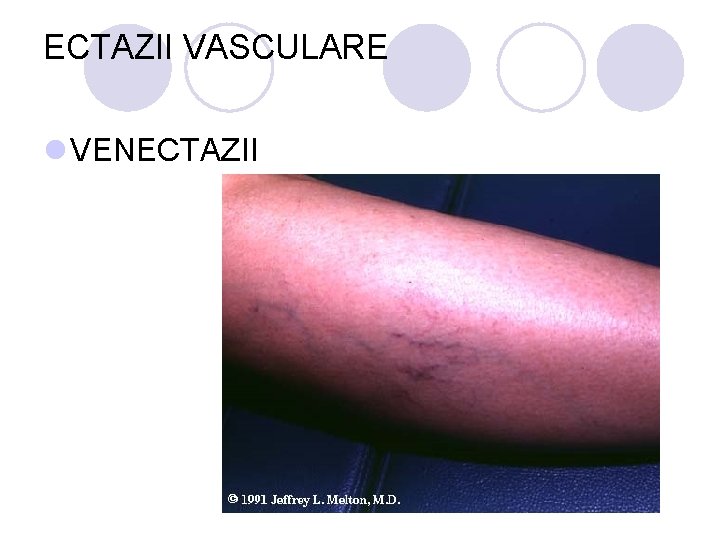 ECTAZII VASCULARE l VENECTAZII ECTAZII VASCULARE l VENECTAZII