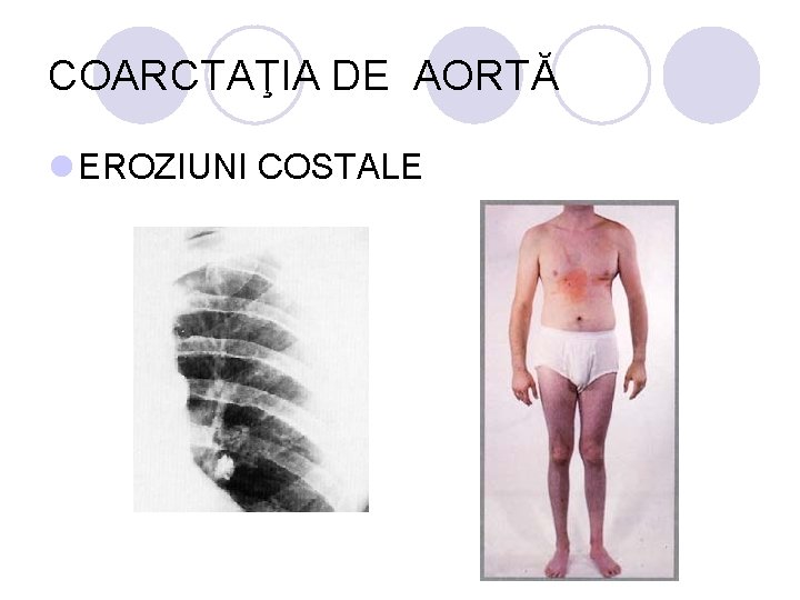 COARCTAŢIA DE AORTĂ l EROZIUNI COSTALE COARCTAŢIA DE AORTĂ l EROZIUNI COSTALE