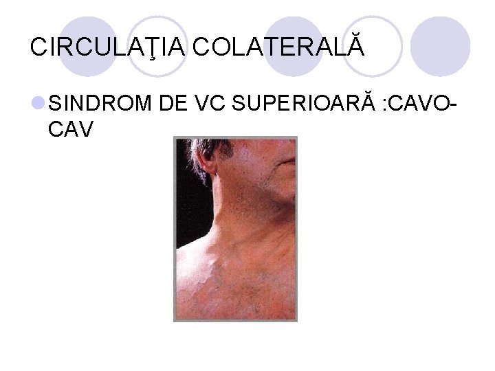 CIRCULAŢIA COLATERALĂ l SINDROM DE VC SUPERIOARĂ : CAVOCAV CIRCULAŢIA COLATERALĂ l SINDROM DE VC SUPERIOARĂ : CAVOCAV