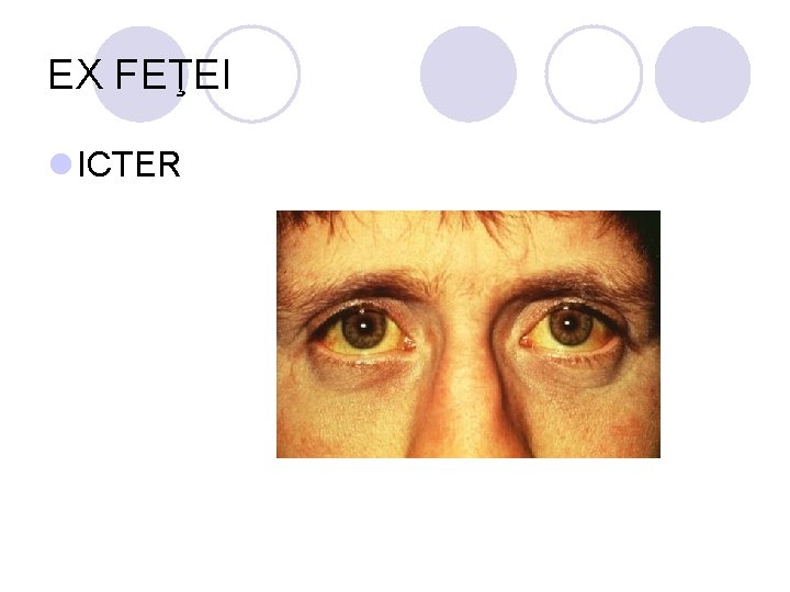 EX FEŢEI l ICTER EX FEŢEI l ICTER