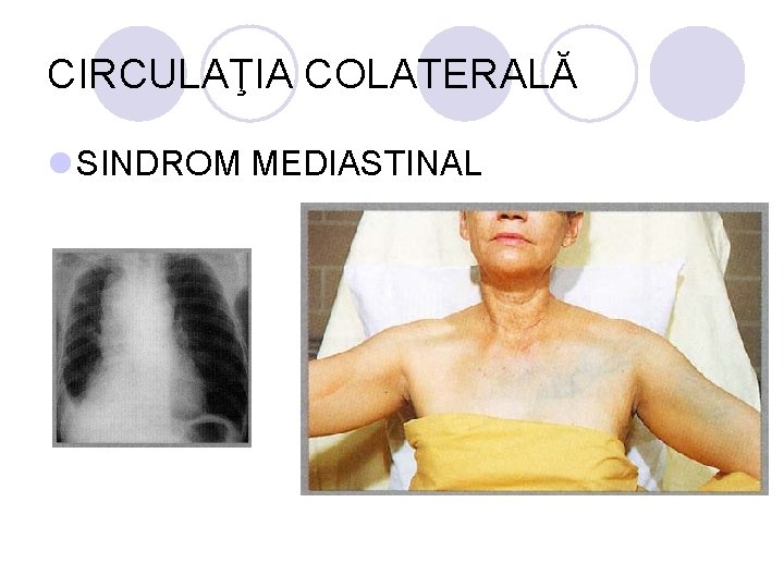 CIRCULAŢIA COLATERALĂ l SINDROM MEDIASTINAL CIRCULAŢIA COLATERALĂ l SINDROM MEDIASTINAL