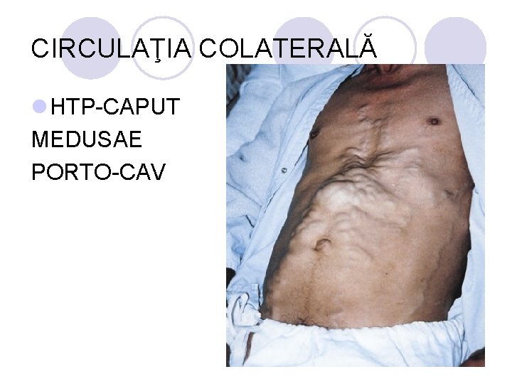 CIRCULAŢIA COLATERALĂ l HTP-CAPUT MEDUSAE PORTO-CAV CIRCULAŢIA COLATERALĂ l HTP-CAPUT MEDUSAE PORTO-CAV