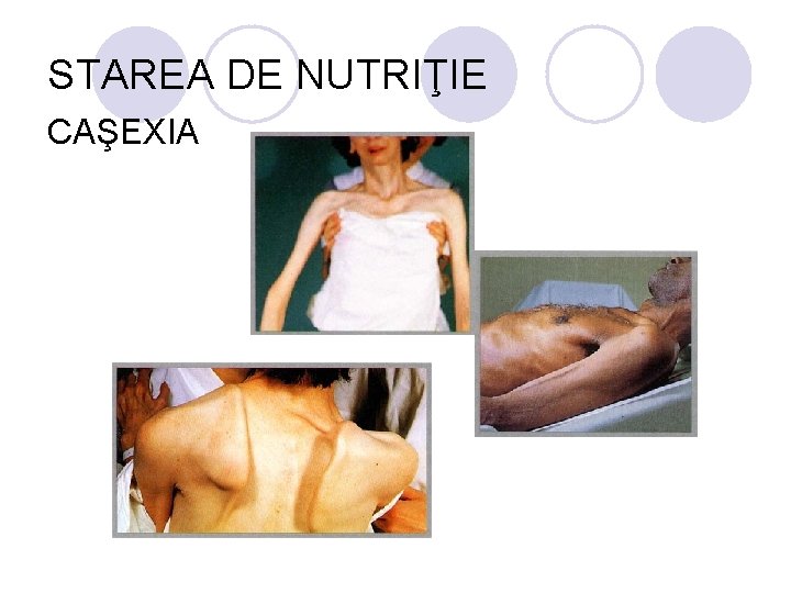 STAREA DE NUTRIŢIE CAŞEXIA STAREA DE NUTRIŢIE CAŞEXIA