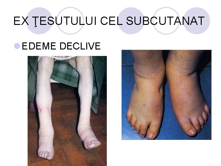 EX ŢESUTULUI CEL SUBCUTANAT l EDEME DECLIVE EX ŢESUTULUI CEL SUBCUTANAT l EDEME DECLIVE