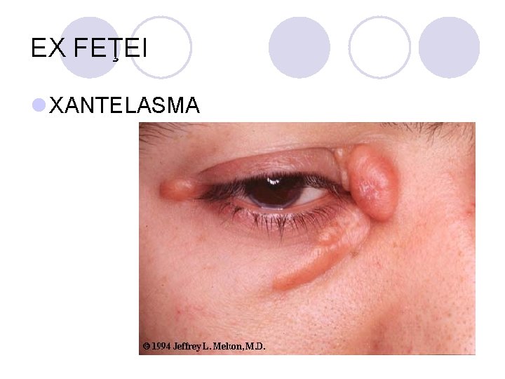 EX FEŢEI l XANTELASMA EX FEŢEI l XANTELASMA